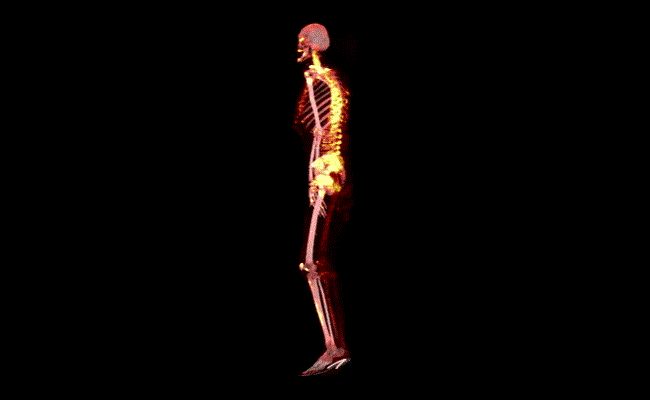 BADANIA SCYNTYGRAFICZNE  SPECT/CT